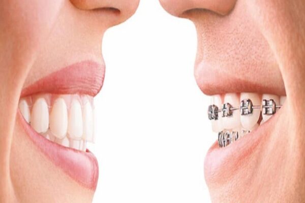 5 Advantages You Can Get With toothsi Clear Aligners