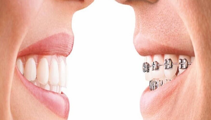 toothsi Clear Aligners
